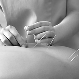 Acupuncture treatment for holistic healing and natural healthcare.